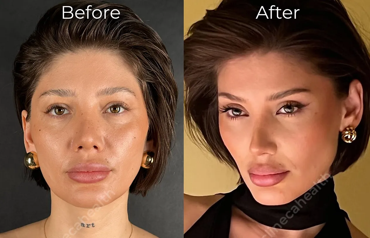 Brow Lift — before and after