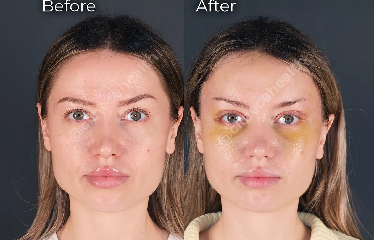 Brow Lift — before and after