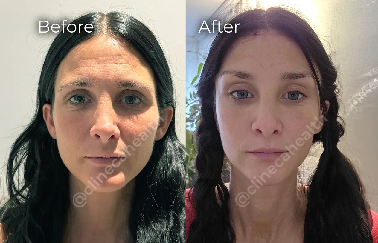 Brow Lift — before and after