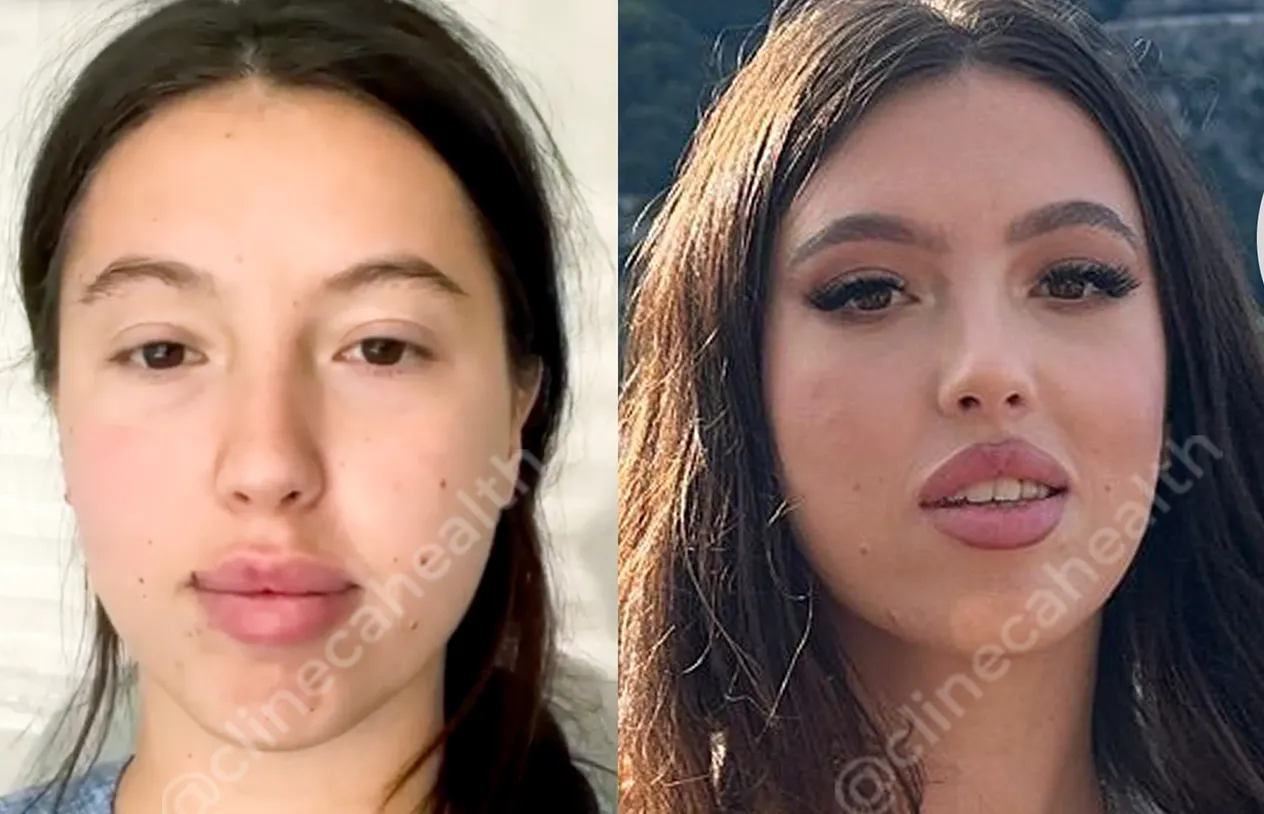 Brow Lift — before and after