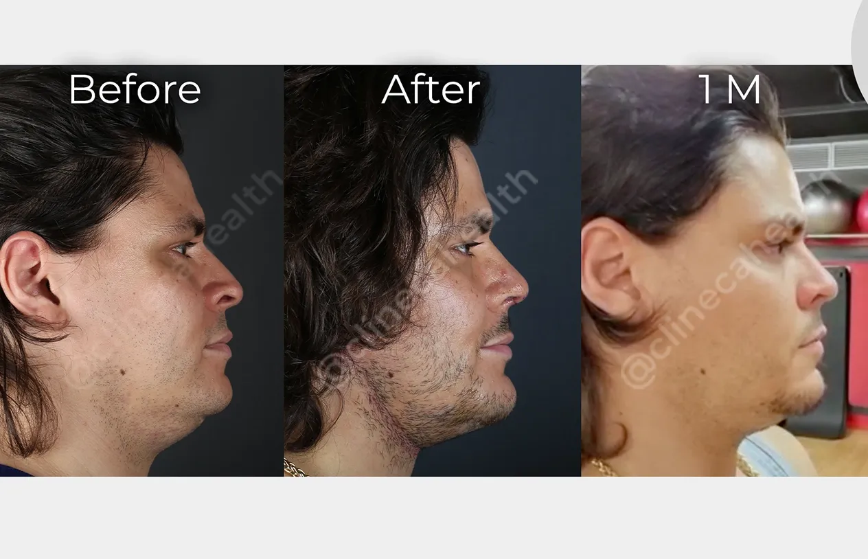 Chin Augmentation — before and after