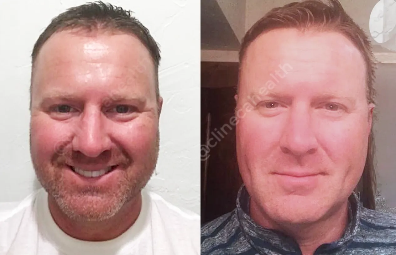 Dimple Surgery — before and after