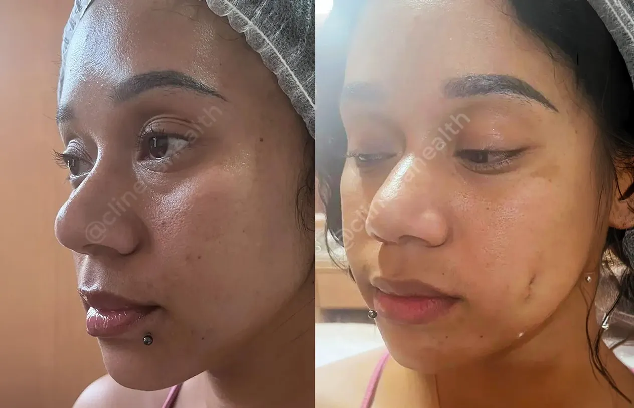 Dimple Surgery — before and after