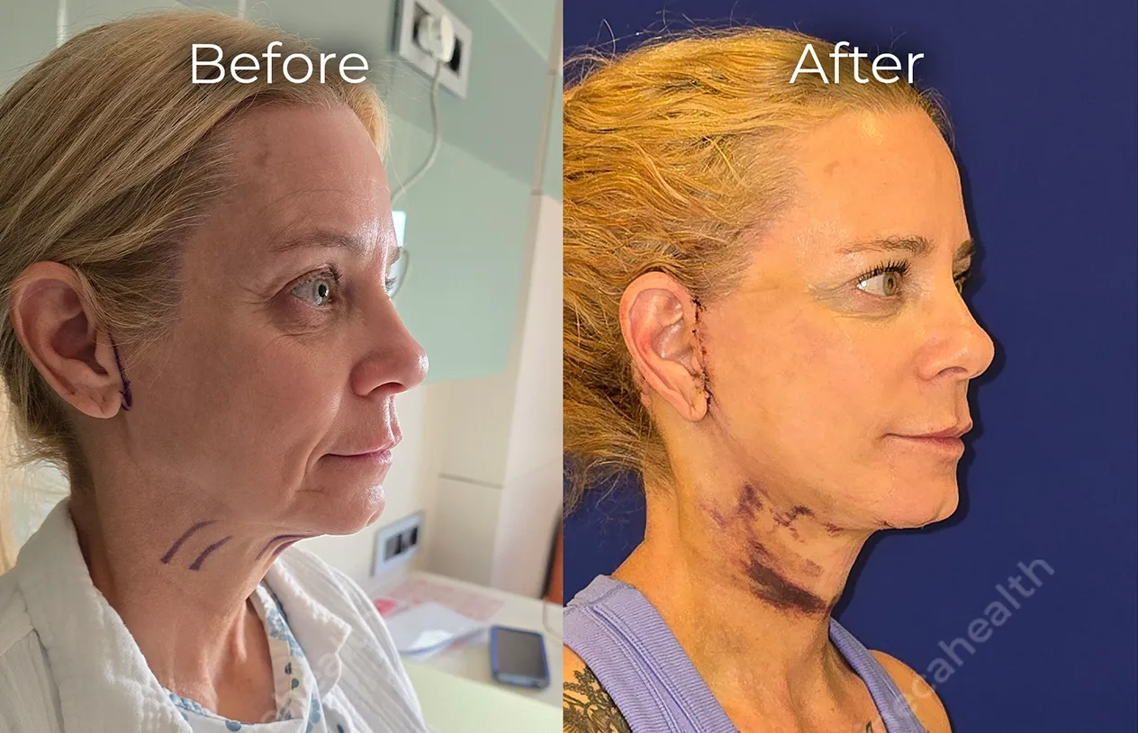 Neck Lift — before and after