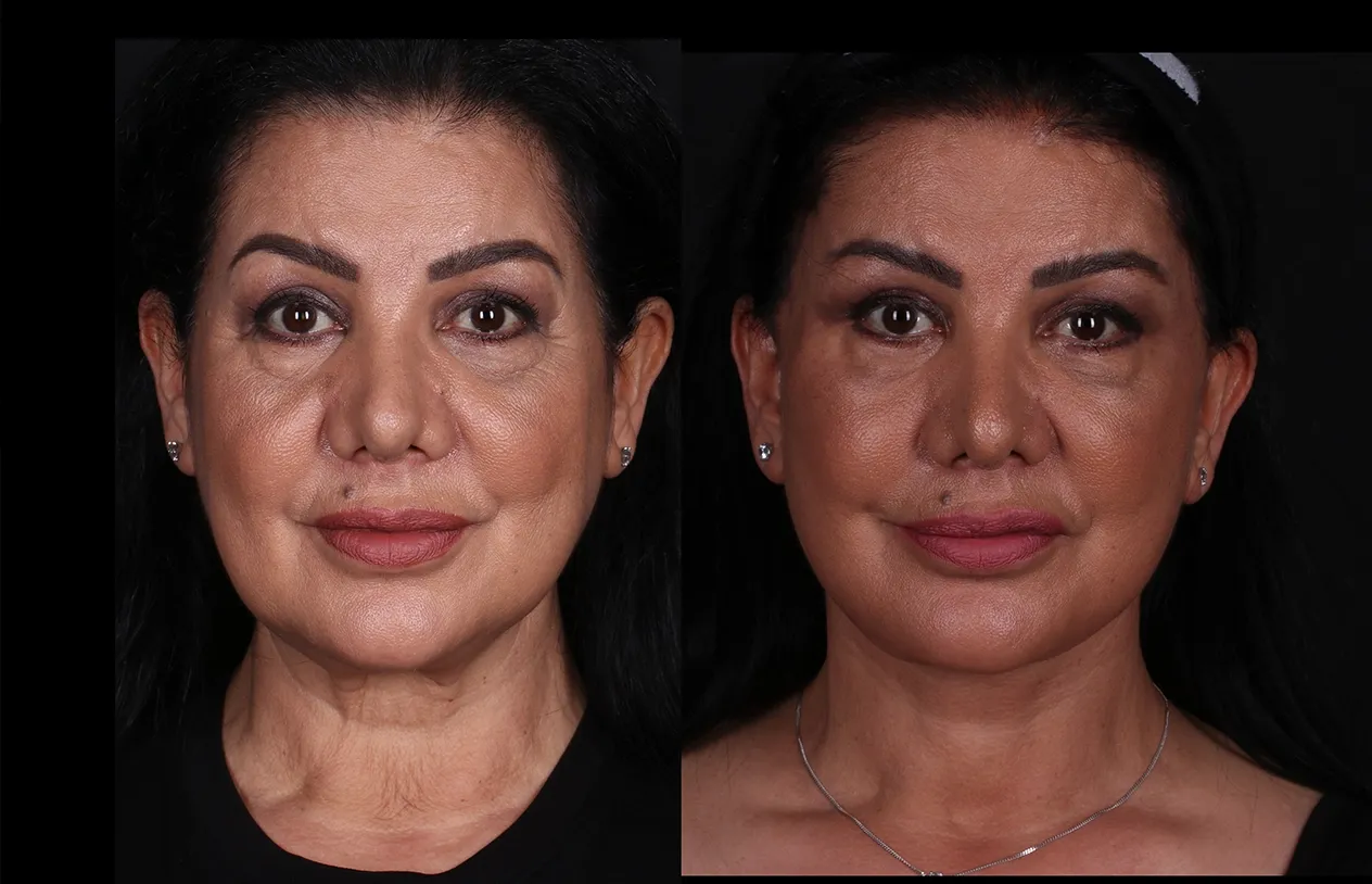Neck Lift — before and after