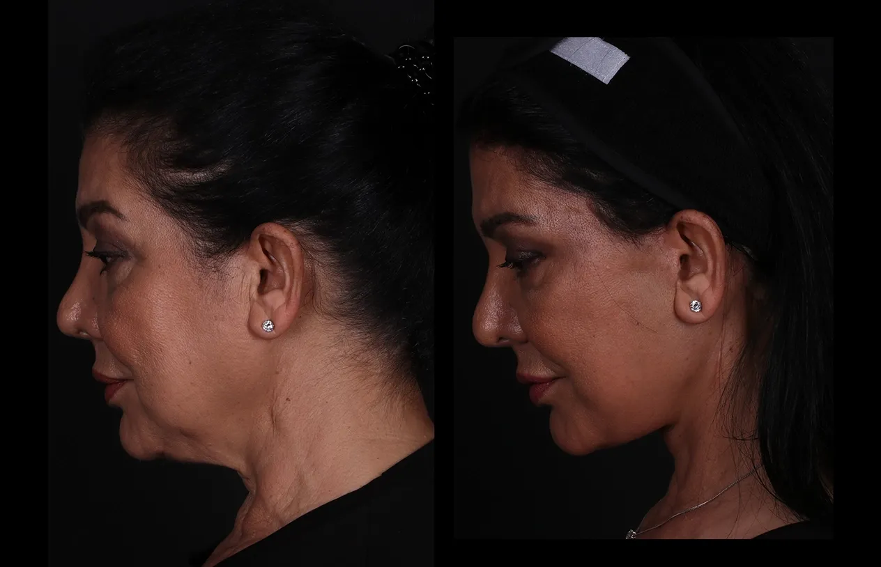 Neck Lift — before and after