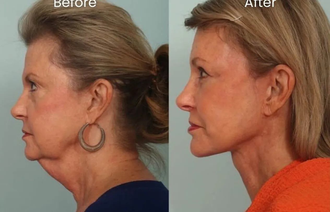 Neck Lift — before and after