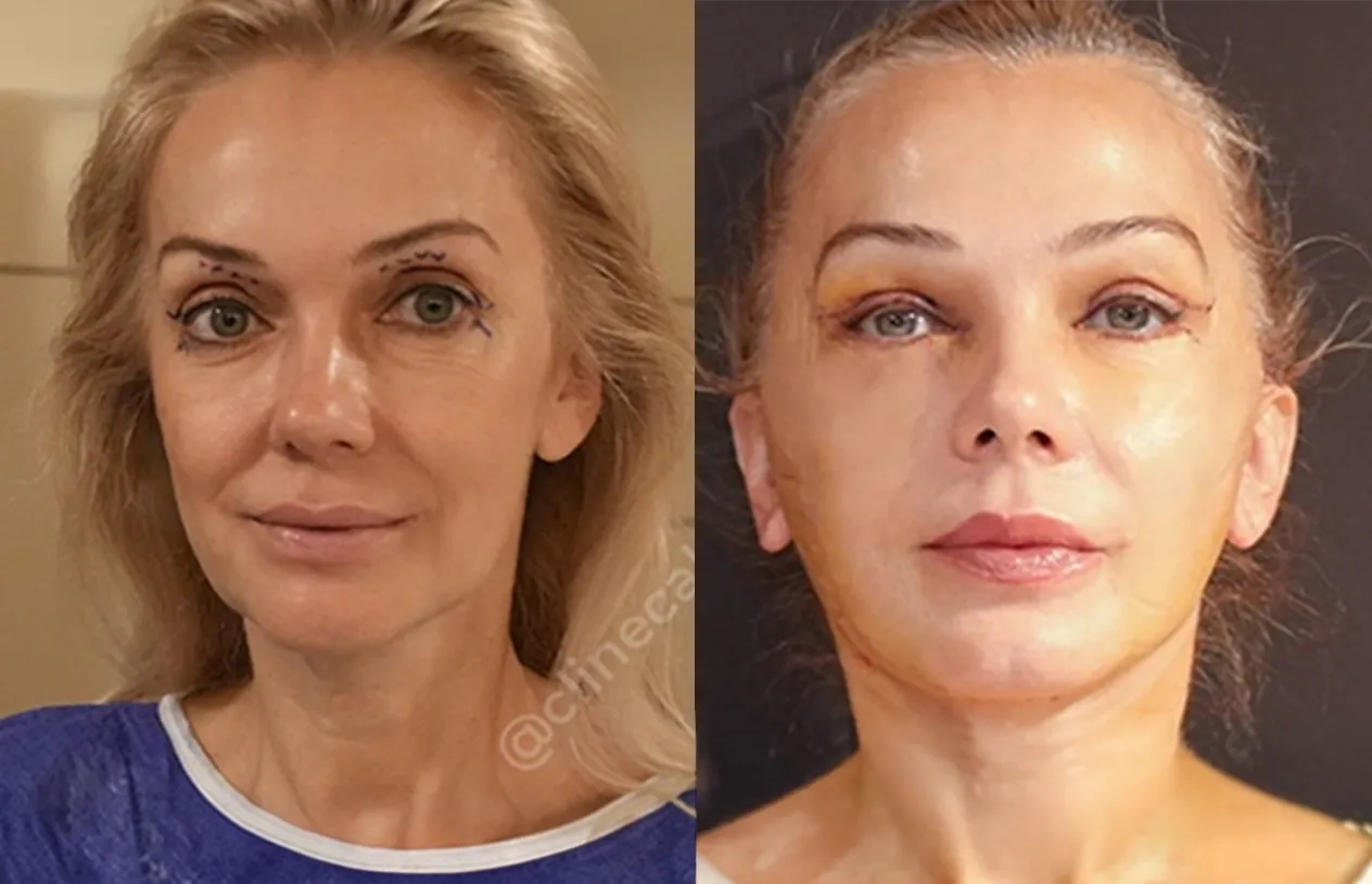 Facelift — before and after