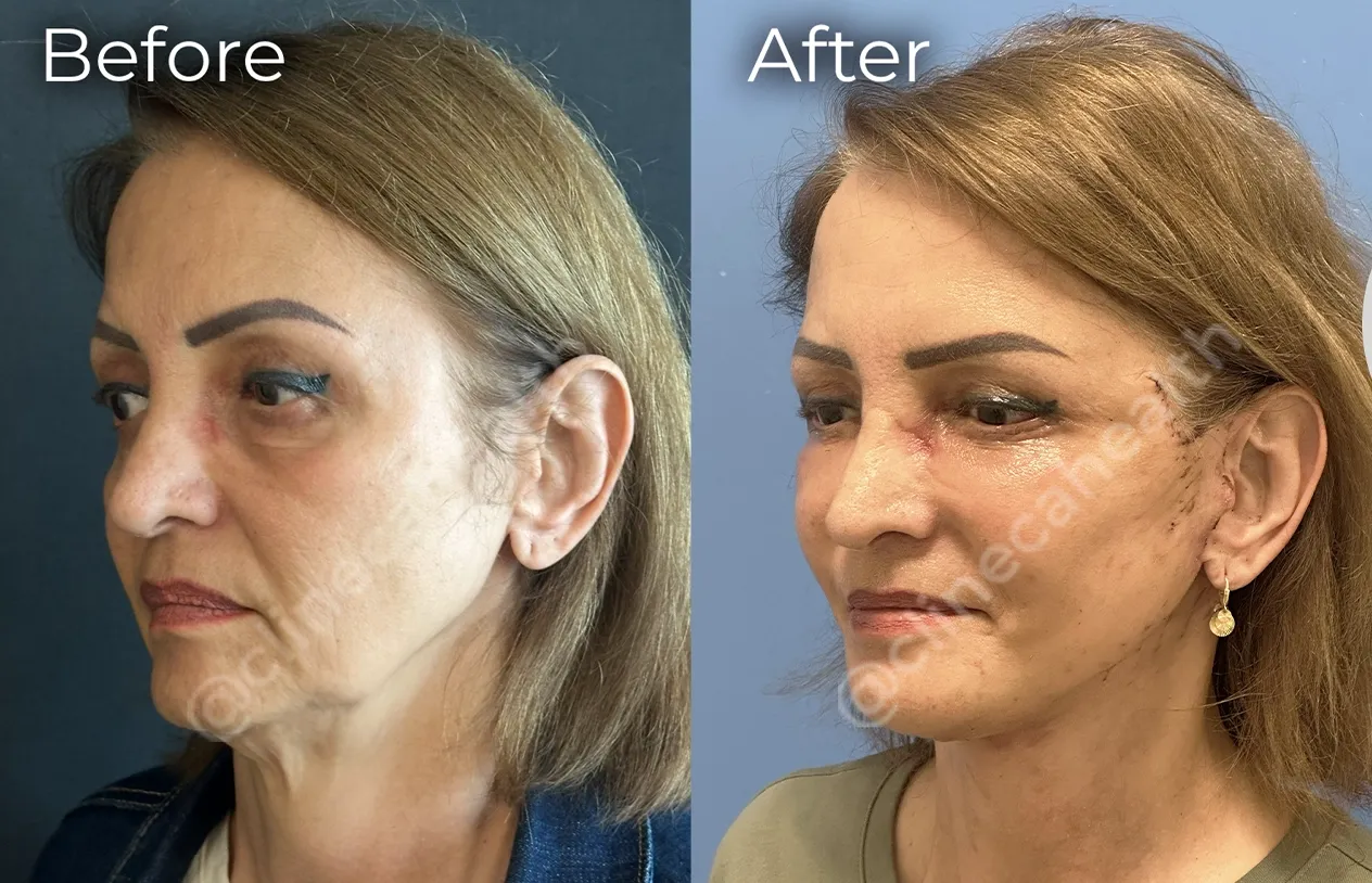 Facelift — before and after