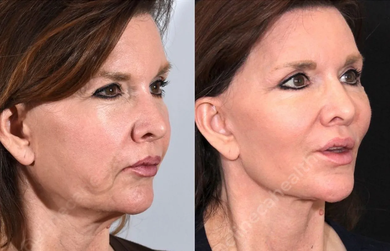 Facelift — before and after