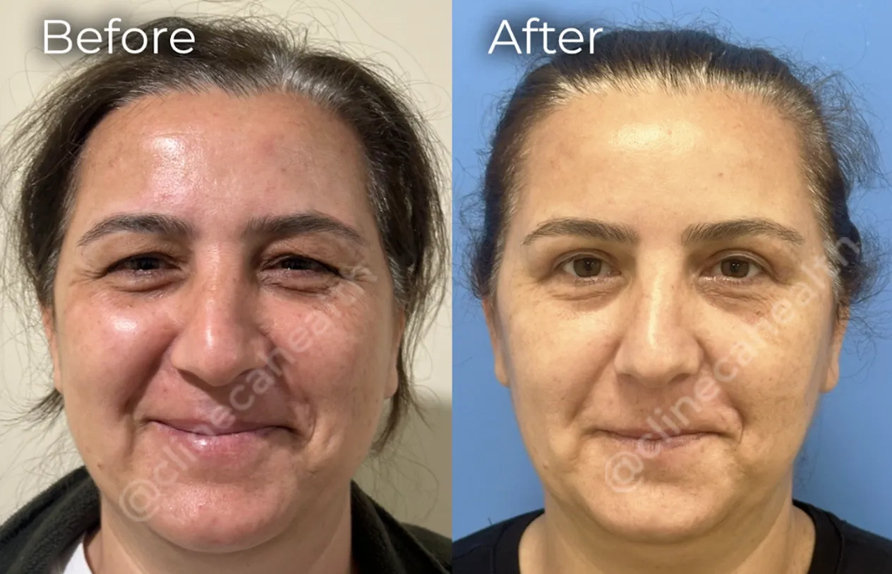 Eyelid Surgery — before and after