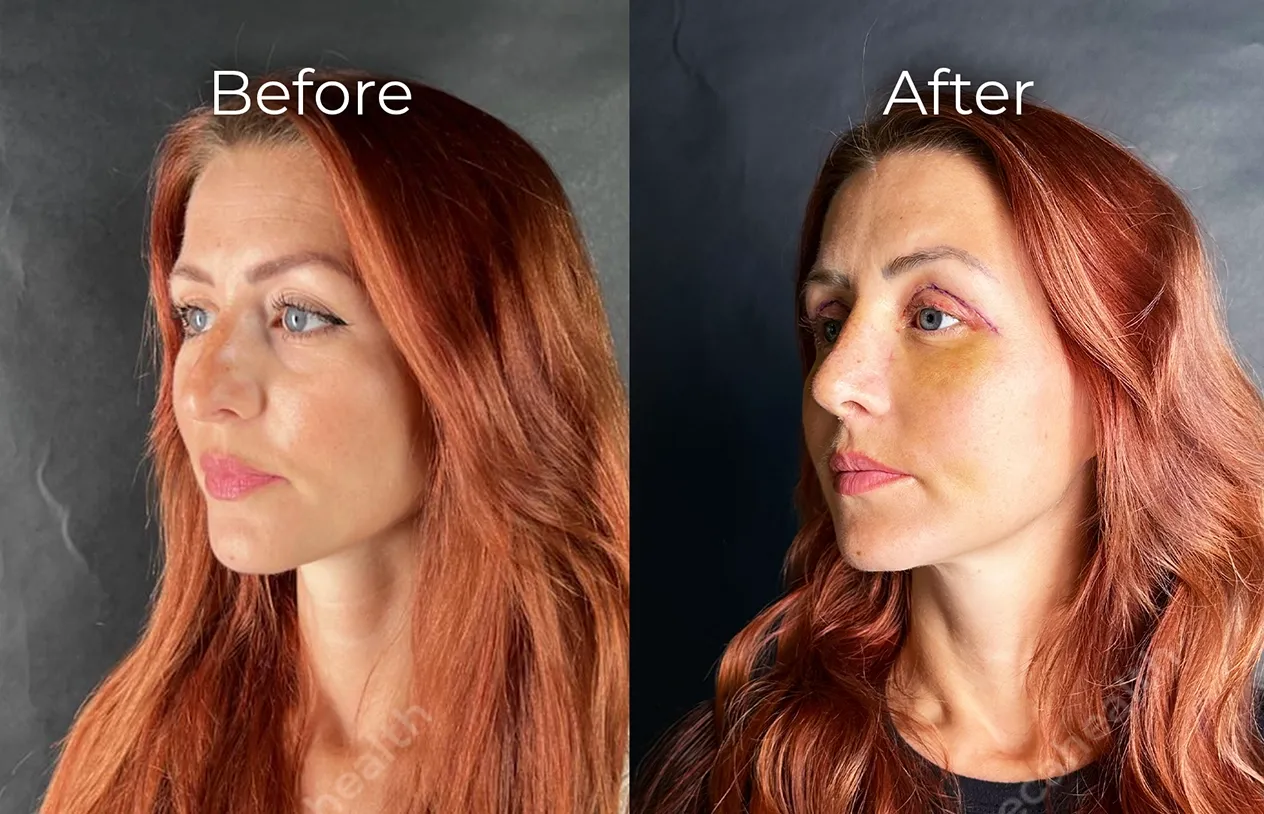 Eyelid Surgery — before and after