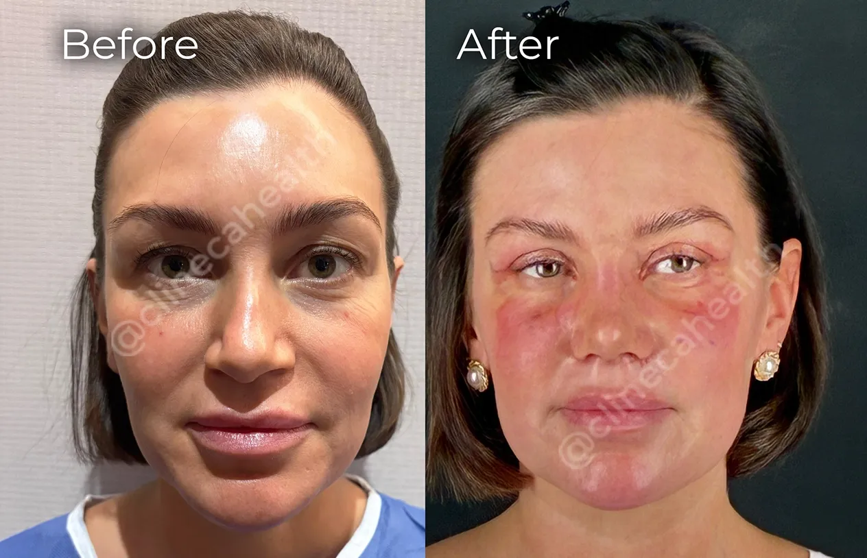 Eyelid Surgery — before and after