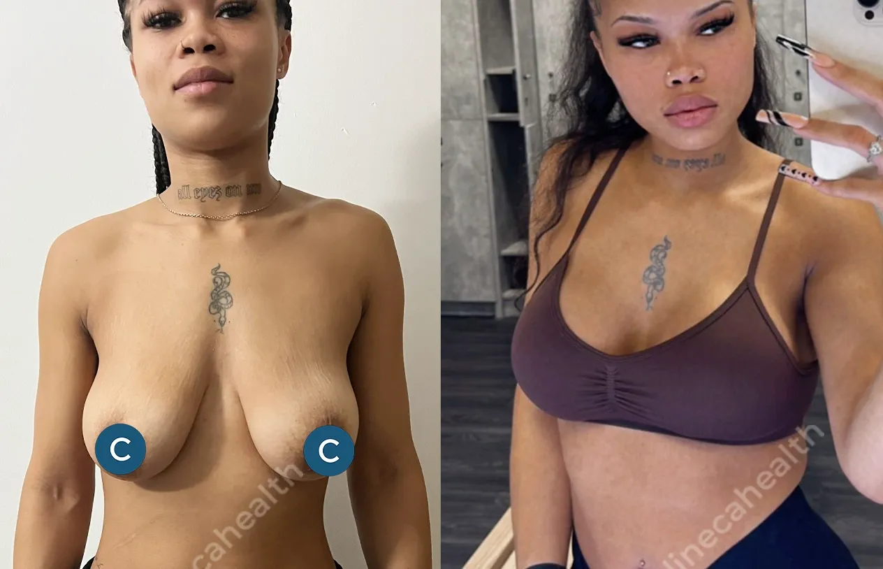 Breast Lift — before and after