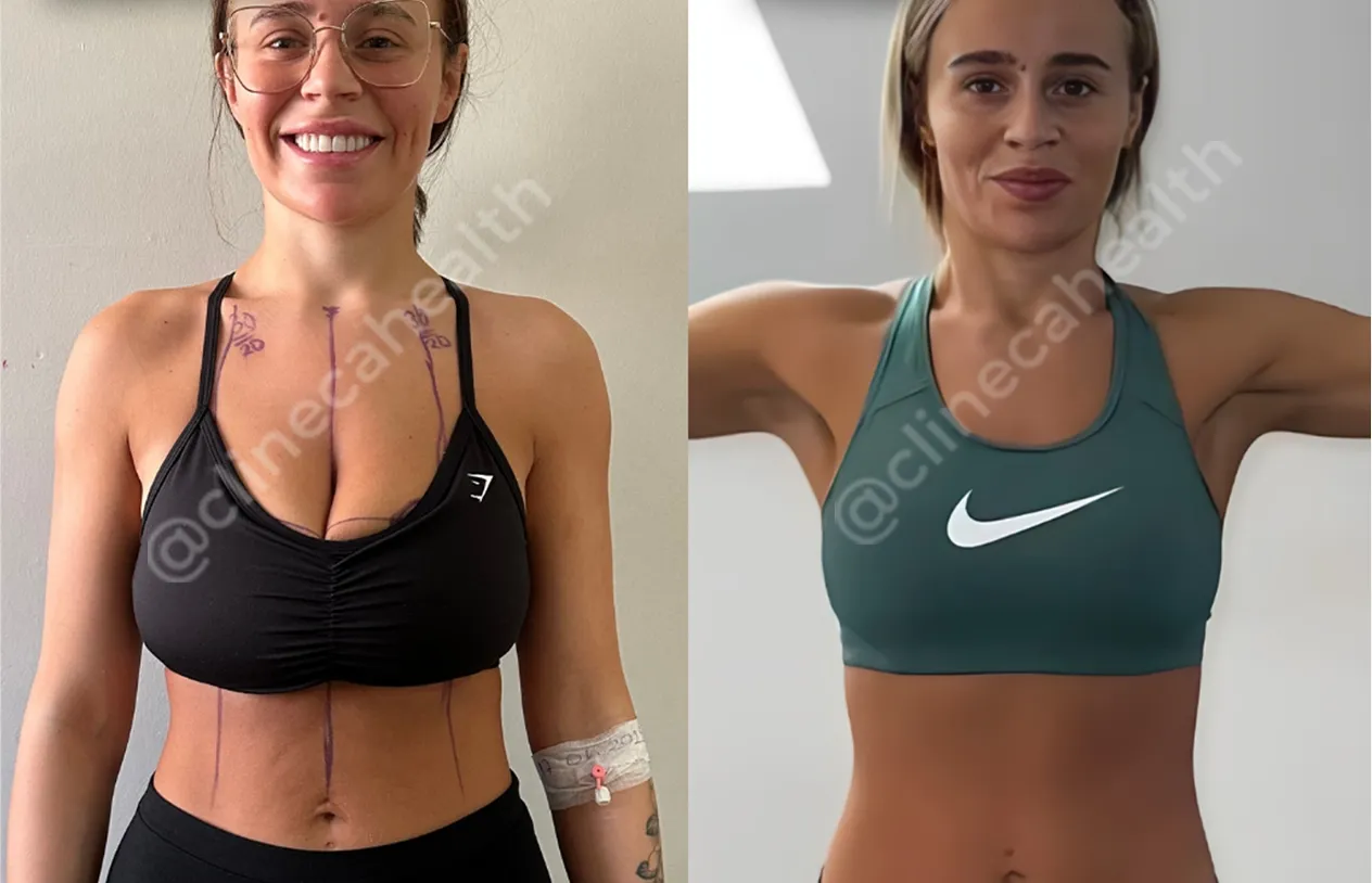 Breast Lift — before and after