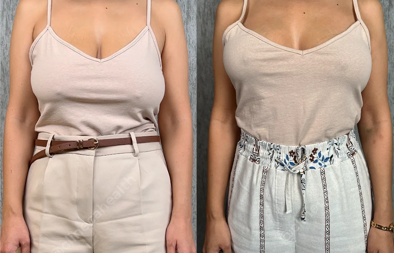 Breast Lift — before and after