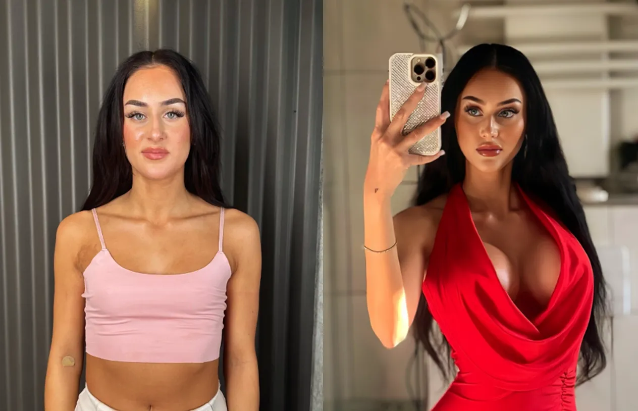 Breast Augmentation — before and after