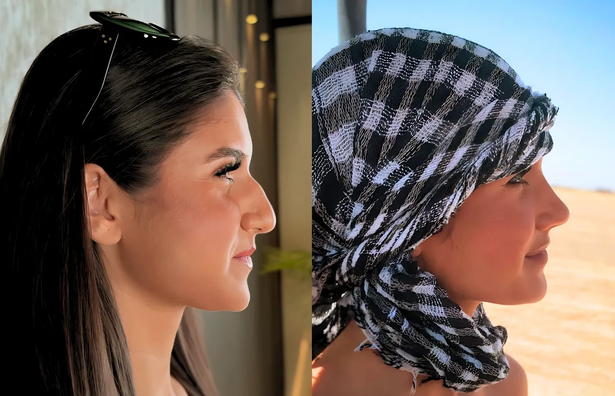Rhinoplasty — before and after