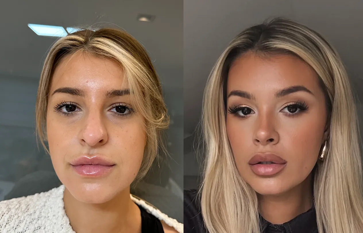 Rhinoplasty — before and after