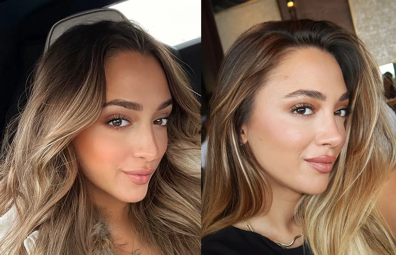 Rhinoplasty — before and after