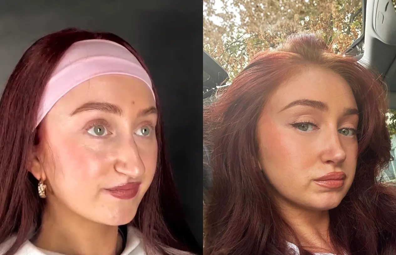 Rhinoplasty — before and after