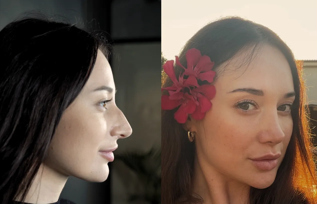 Rhinoplasty — before and after