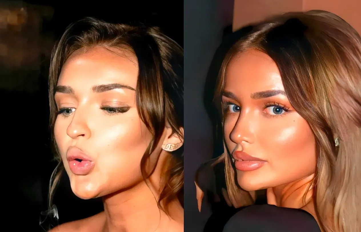 Rhinoplasty — before and after