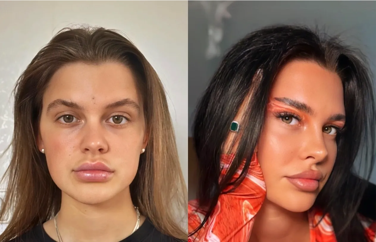 Eyelid Surgery — before and after