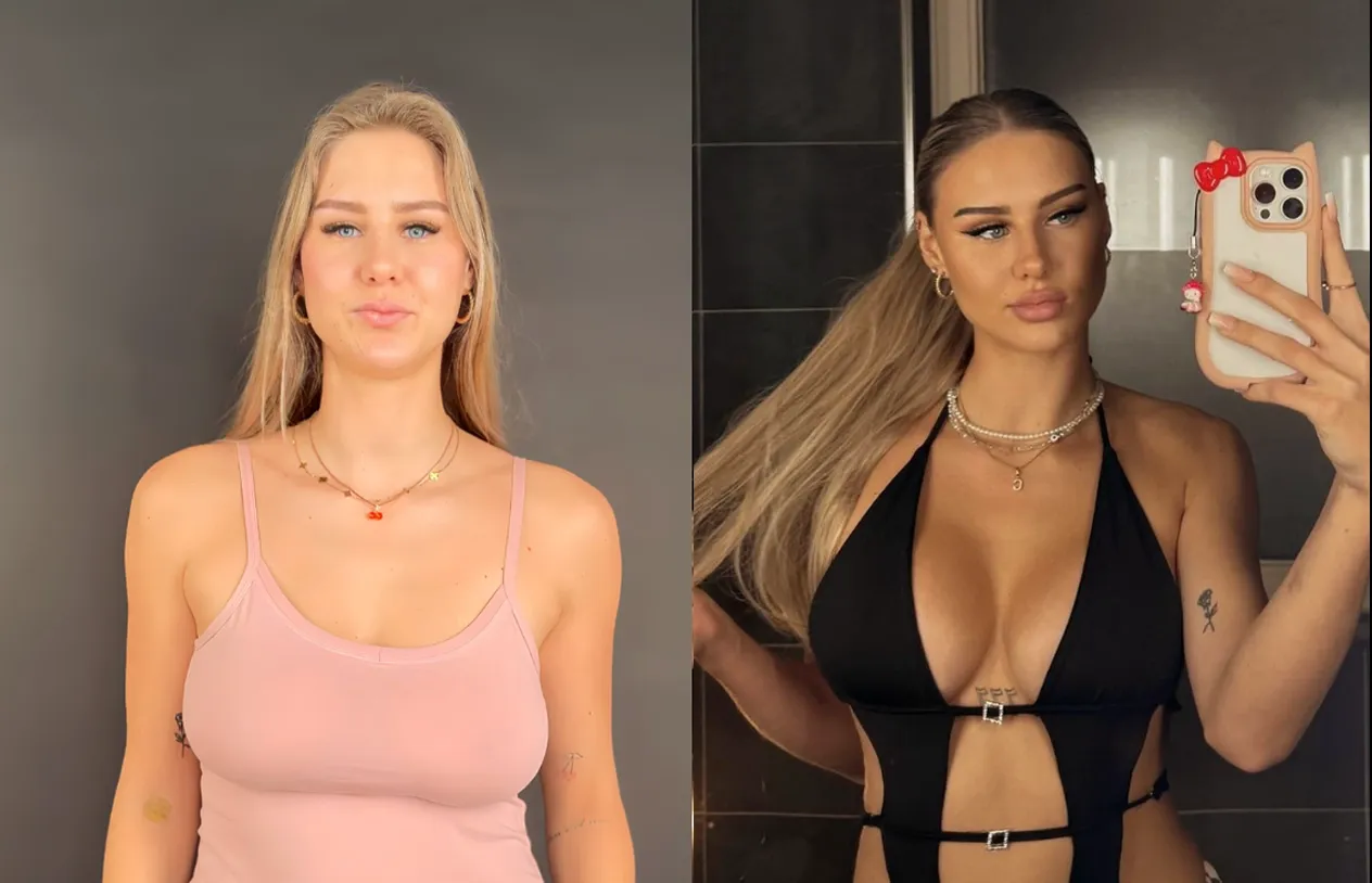 Breast Lift — before and after