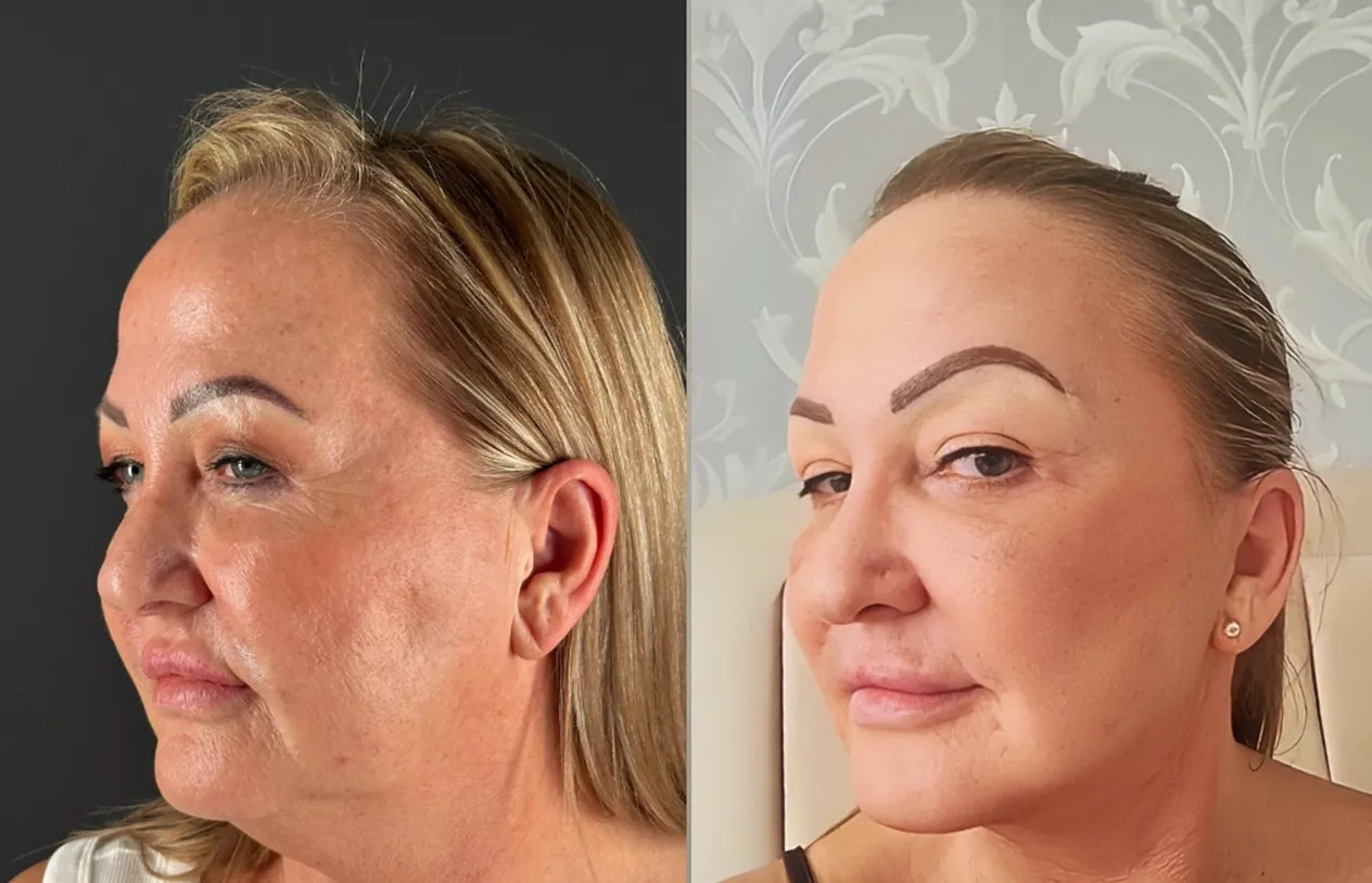 Facelift — before and after