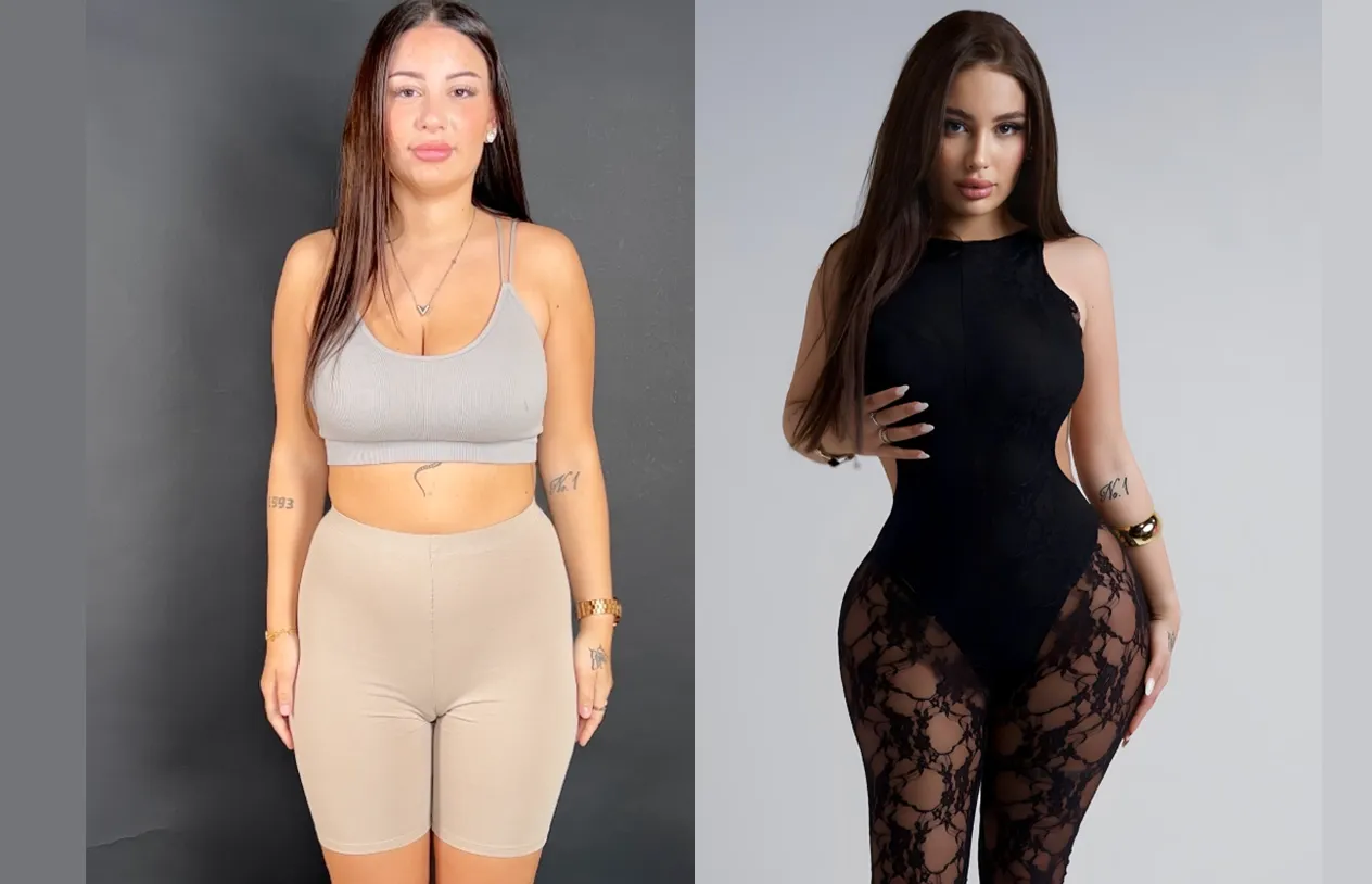 Brazilian Butt Lift — before and after