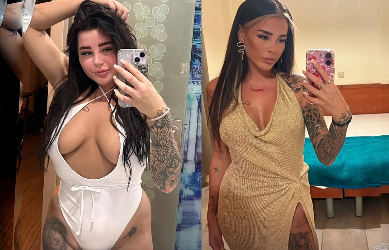 Liposuction — before and after