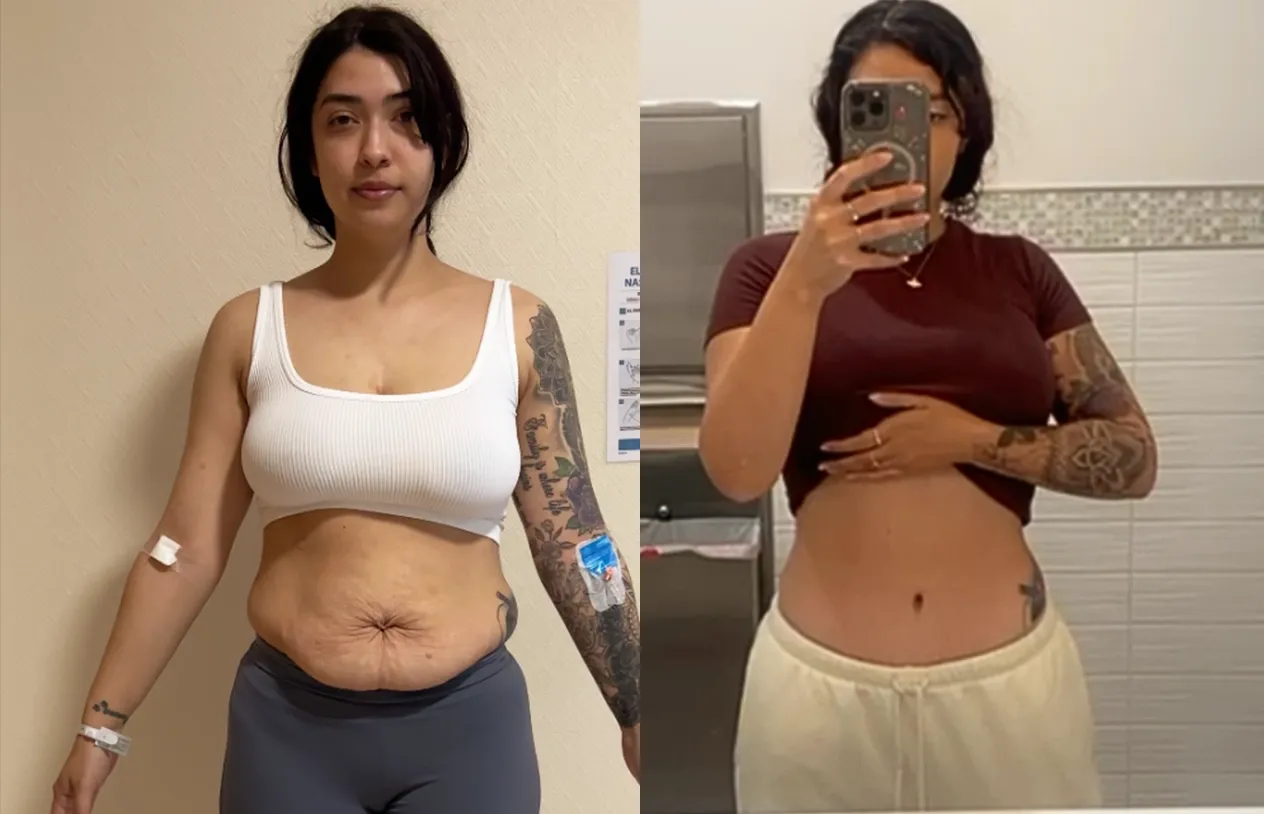 Abdominoplasty — before and after