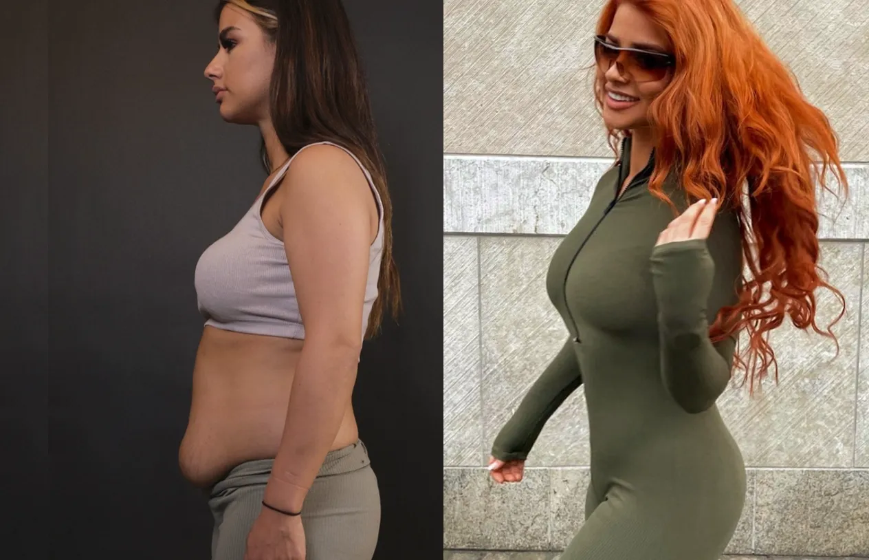 Abdominoplasty — before and after