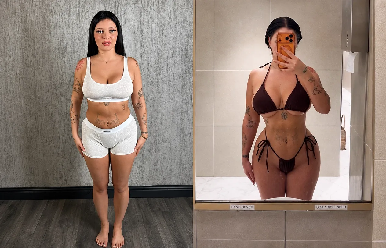 Brazilian Butt Lift — before and after