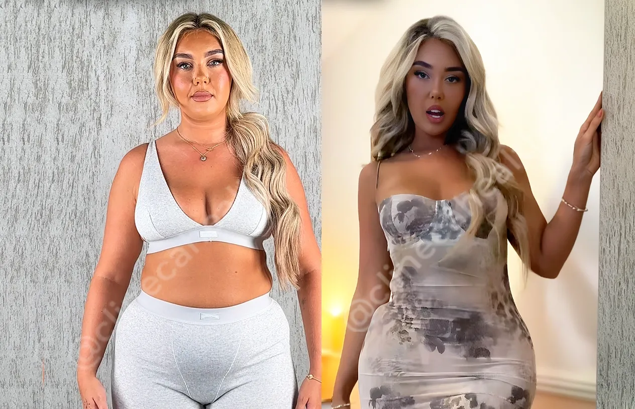 Liposuction — before and after