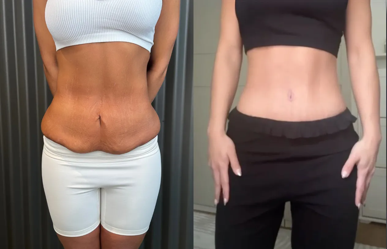 Abdominoplasty — before and after