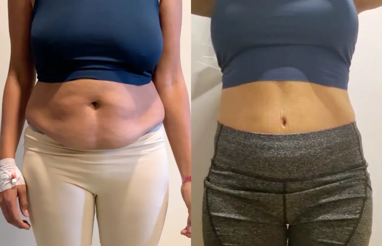 Abdominoplasty — before and after
