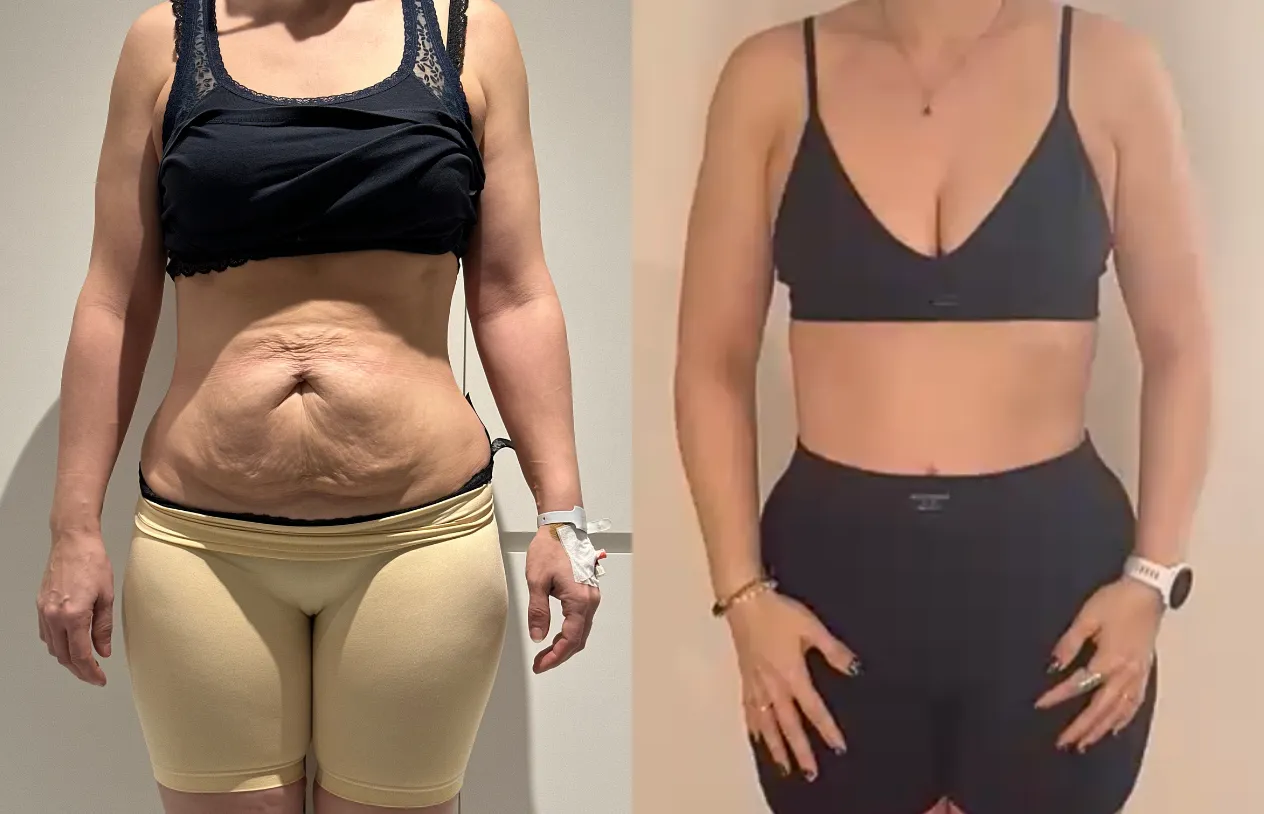 Abdominoplasty — before and after