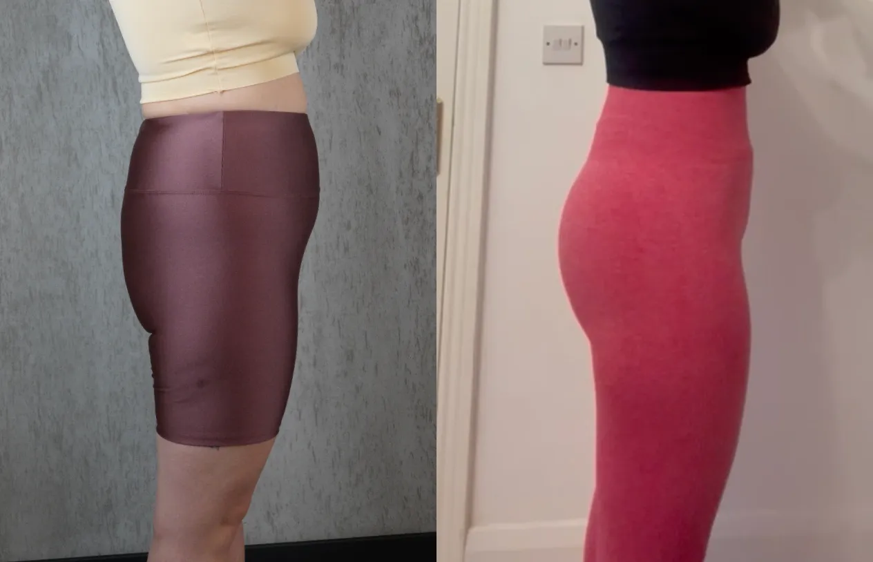 Brazilian Butt Lift — before and after