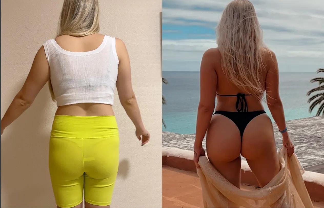 Brazilian Butt Lift — before and after
