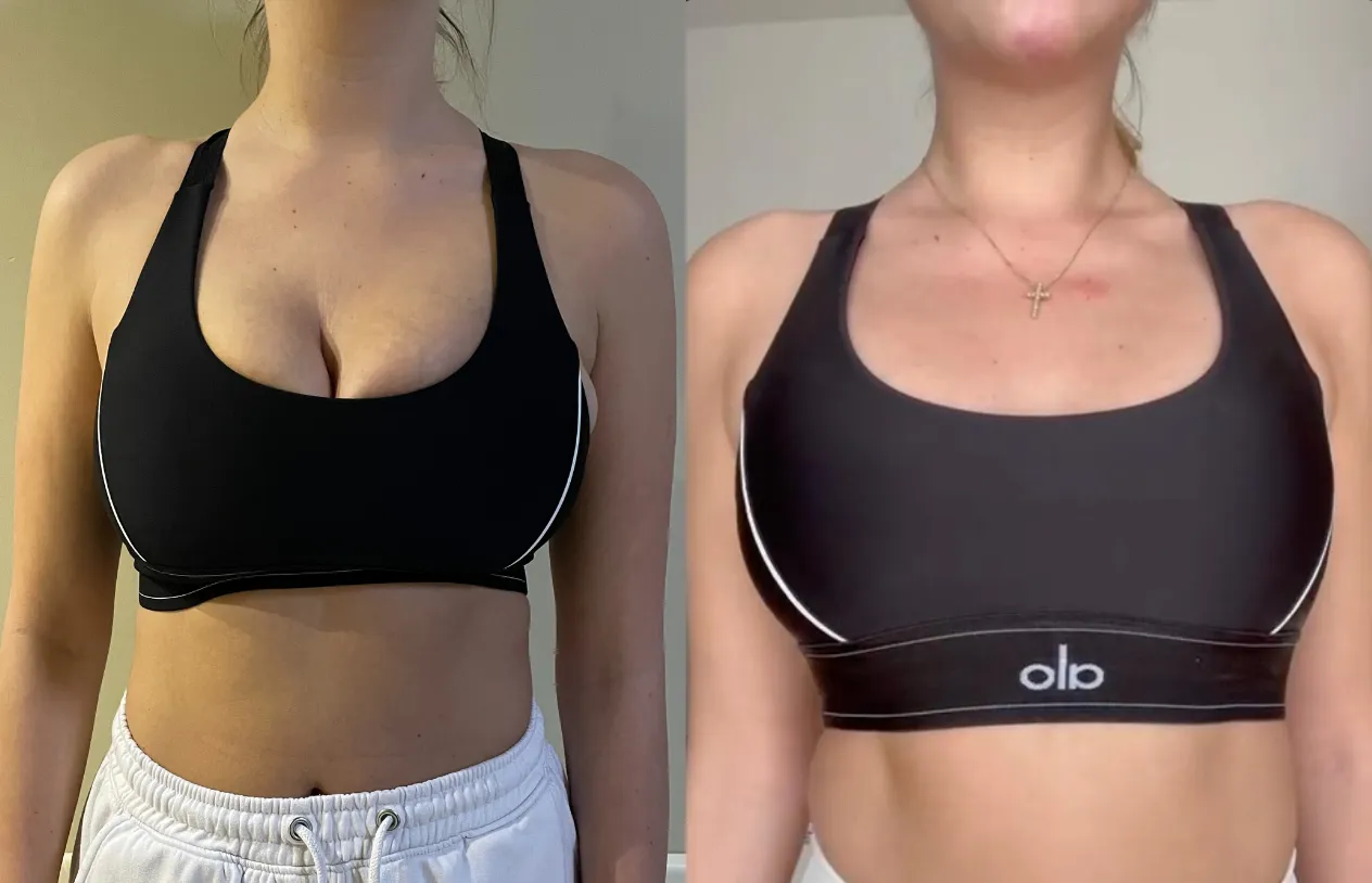 Breast Lift — before and after
