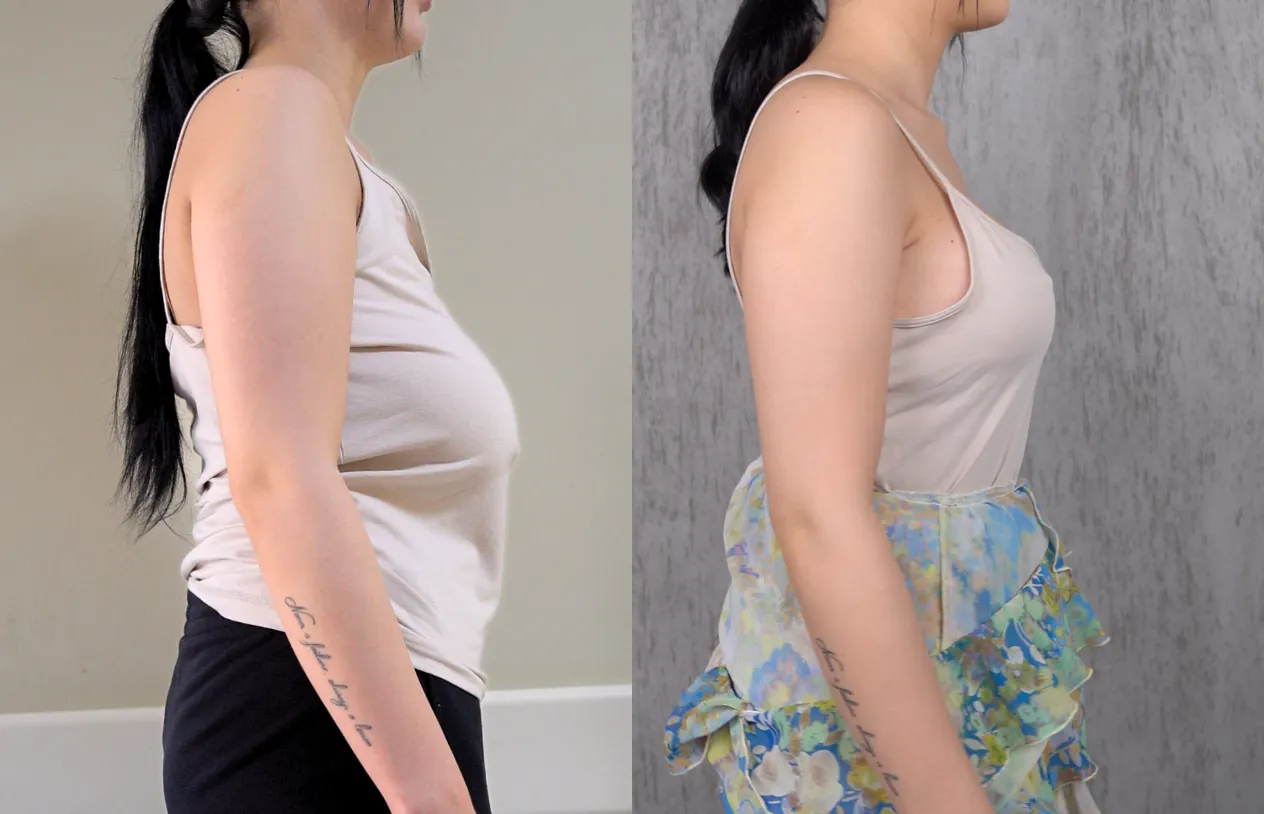 Breast Lift — before and after