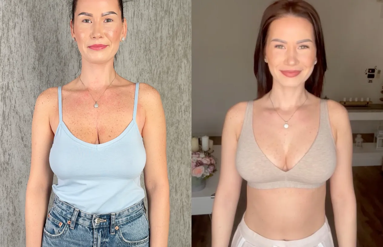 Breast Lift — before and after