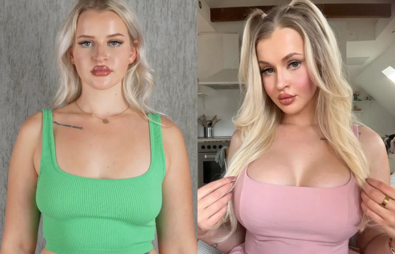Breast Augmentation — before and after