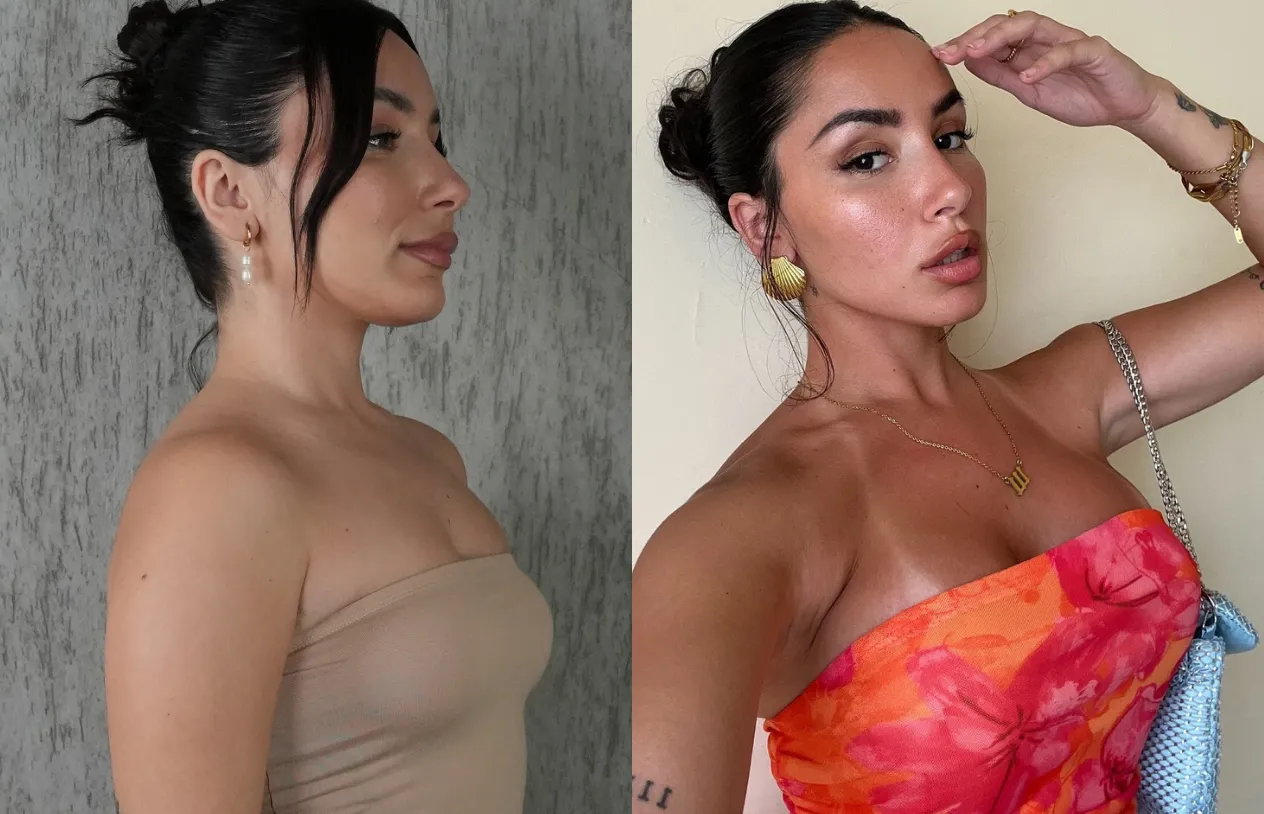Breast Augmentation — before and after