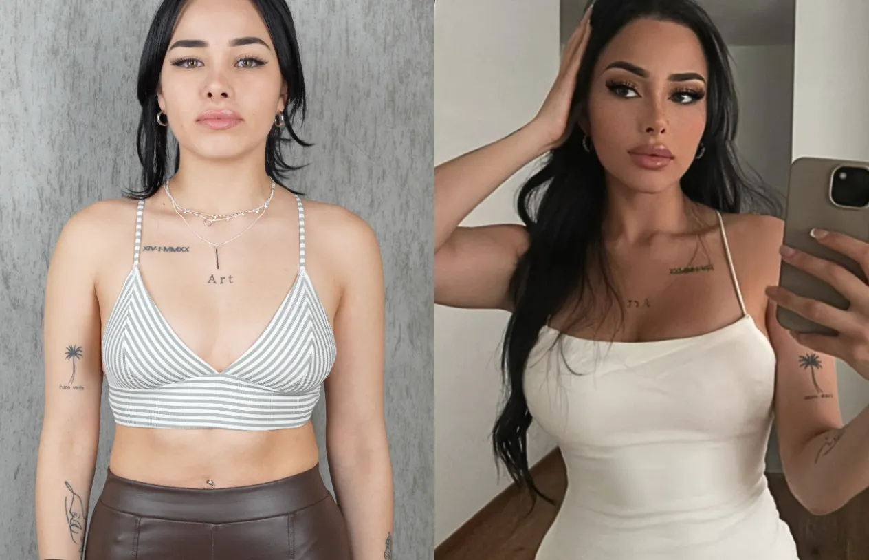 Breast Augmentation — before and after
