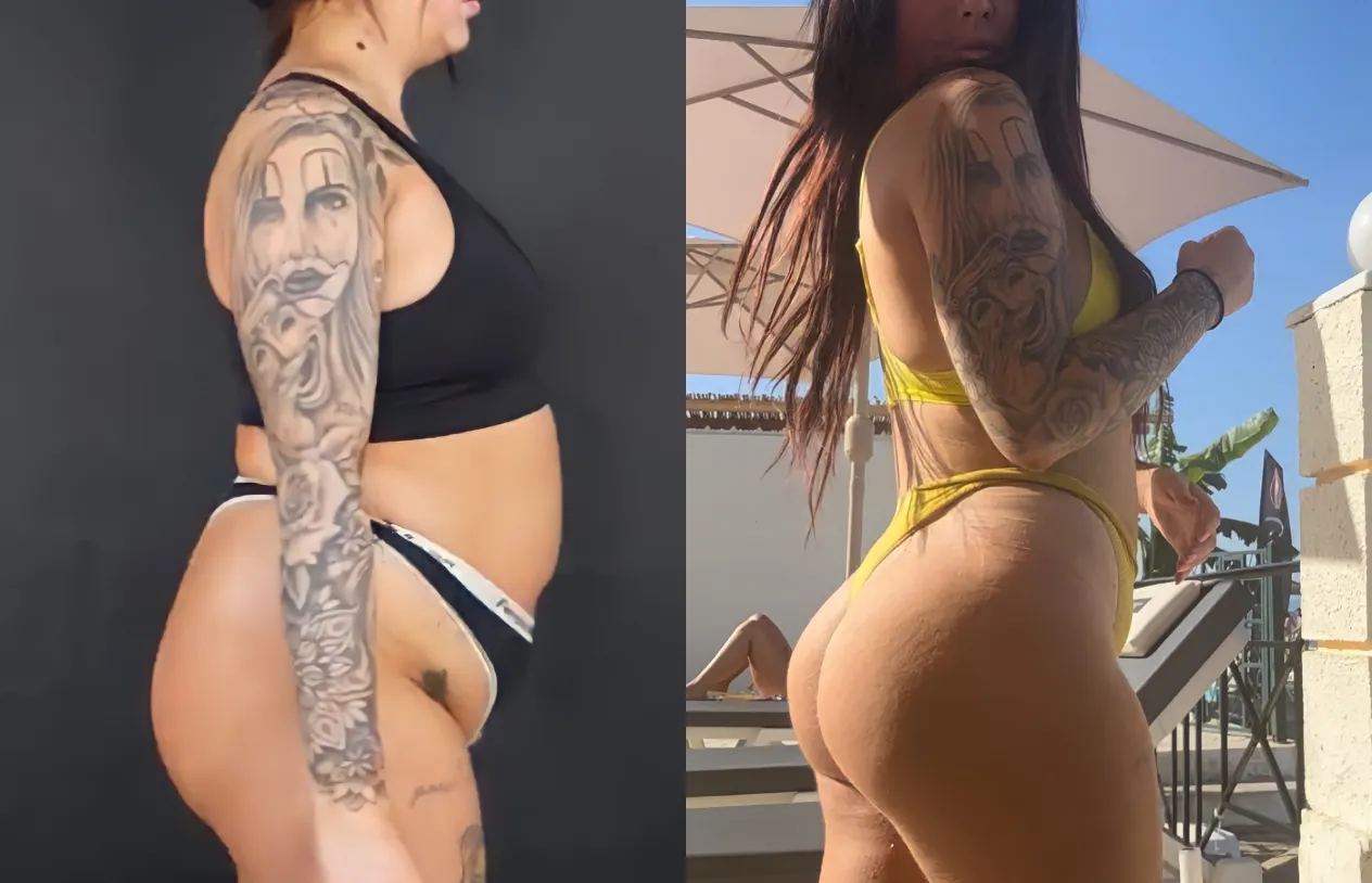 Liposuction — before and after