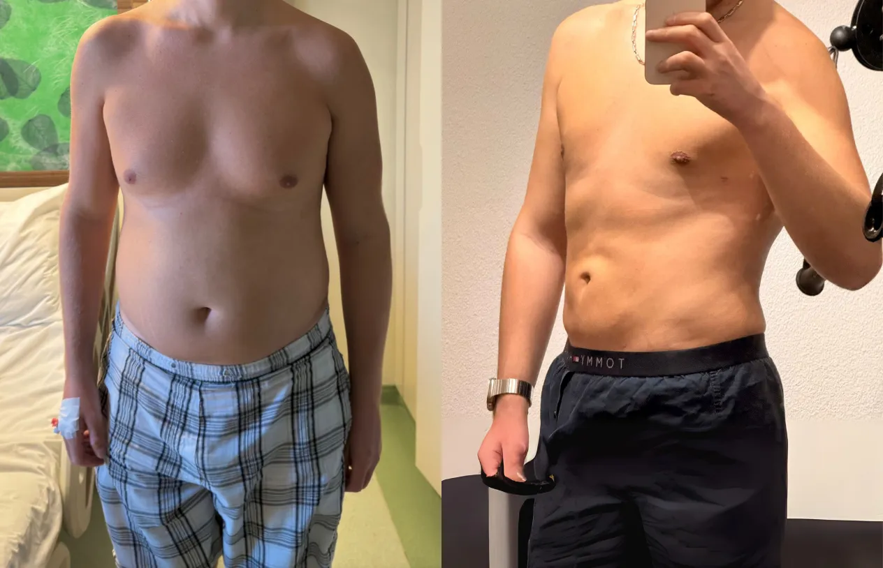 Liposuction — before and after