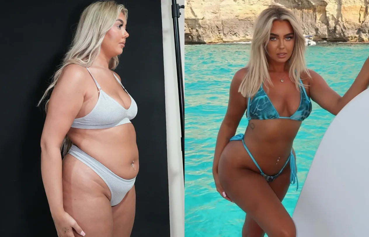 Liposuction — before and after